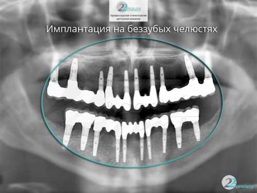 Имплантация зубов