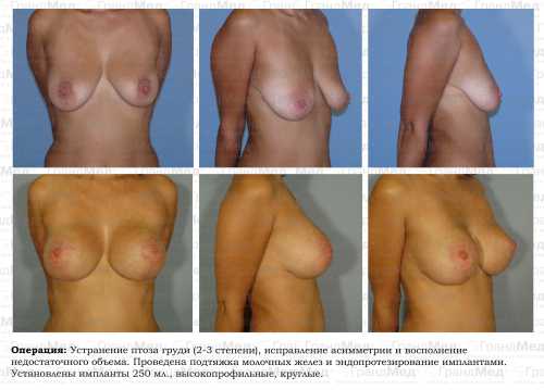 5 способов увеличить грудь без операций