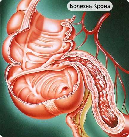 Лечение болезни Крона у детей колит, терминальный илеит