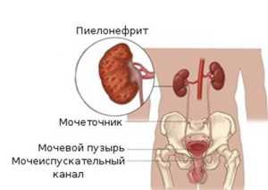 Почему болят почки: диагноз, прогноз, может