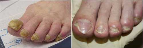 Грибок ногтей на ногах: как диагностировать и чем
