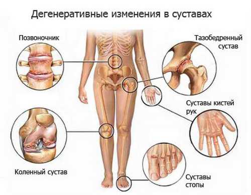 Деформирующий остеоартроз