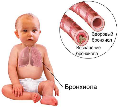 Бронхиолит у детей
